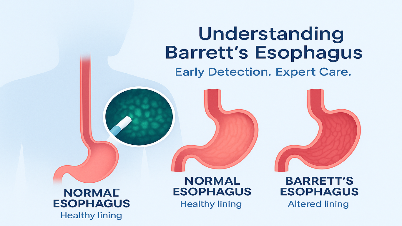barrett’s-esophagus-at-vgm-hospital-gastro-center