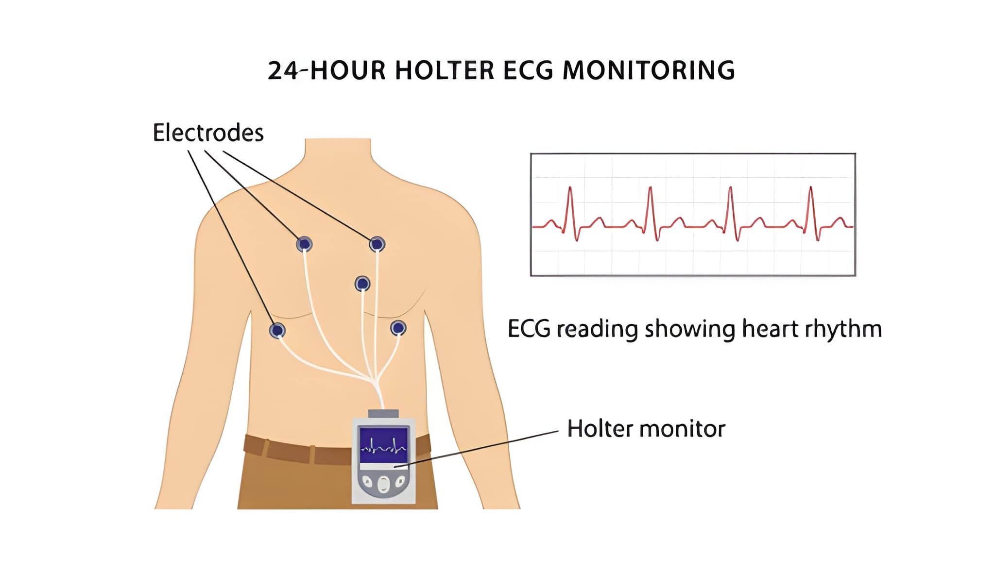 Holter Monitoring