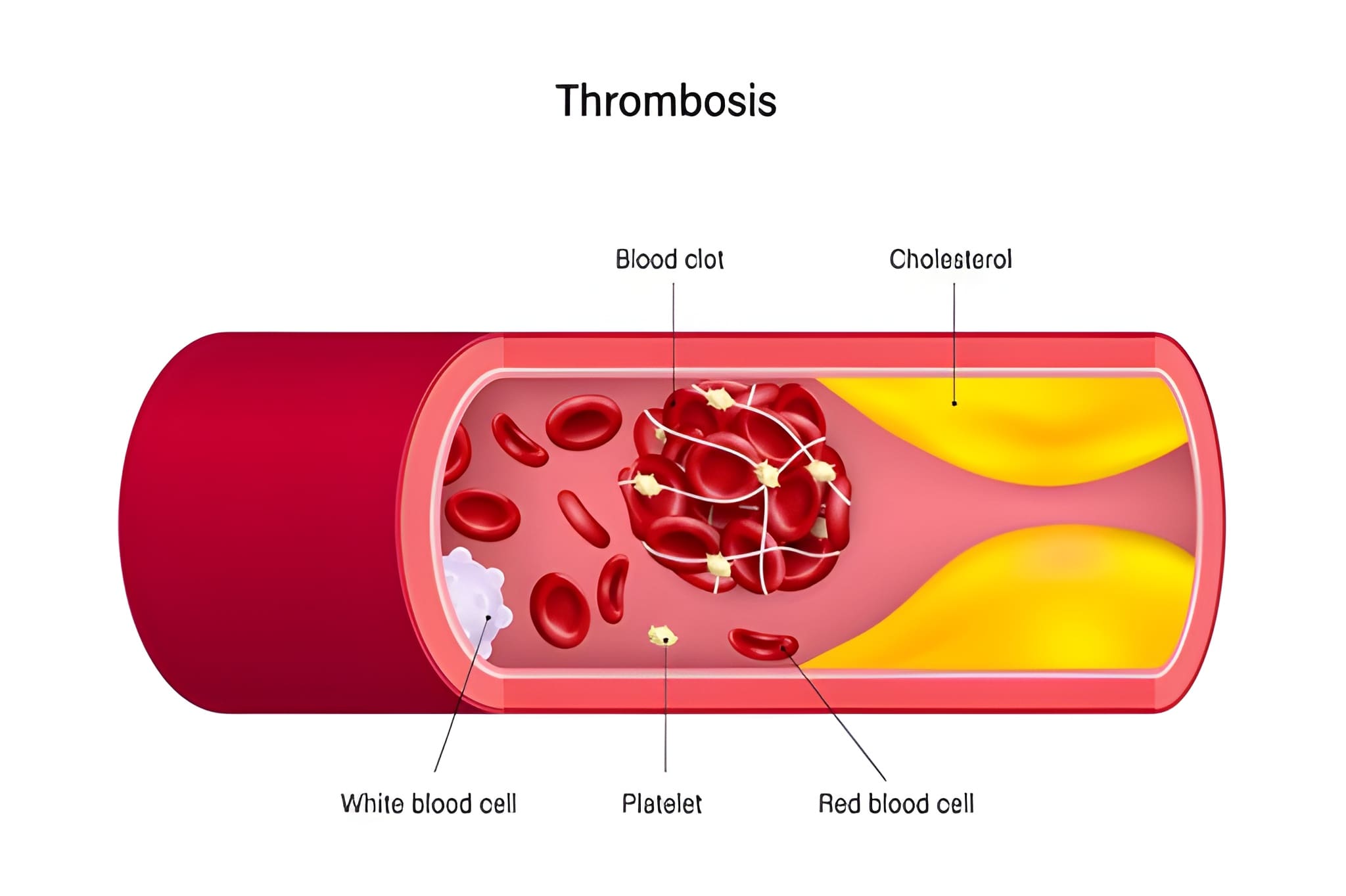 Thrombolysis