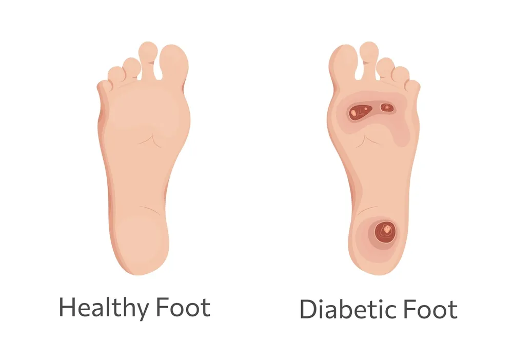 Diabetic Foot Care