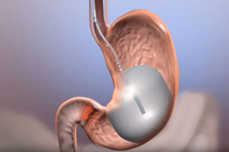 Advanced endoscopic treatment equipment