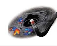 Endoscopic Ultrasonography