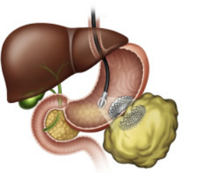 Advanced endoscopic treatment equipment