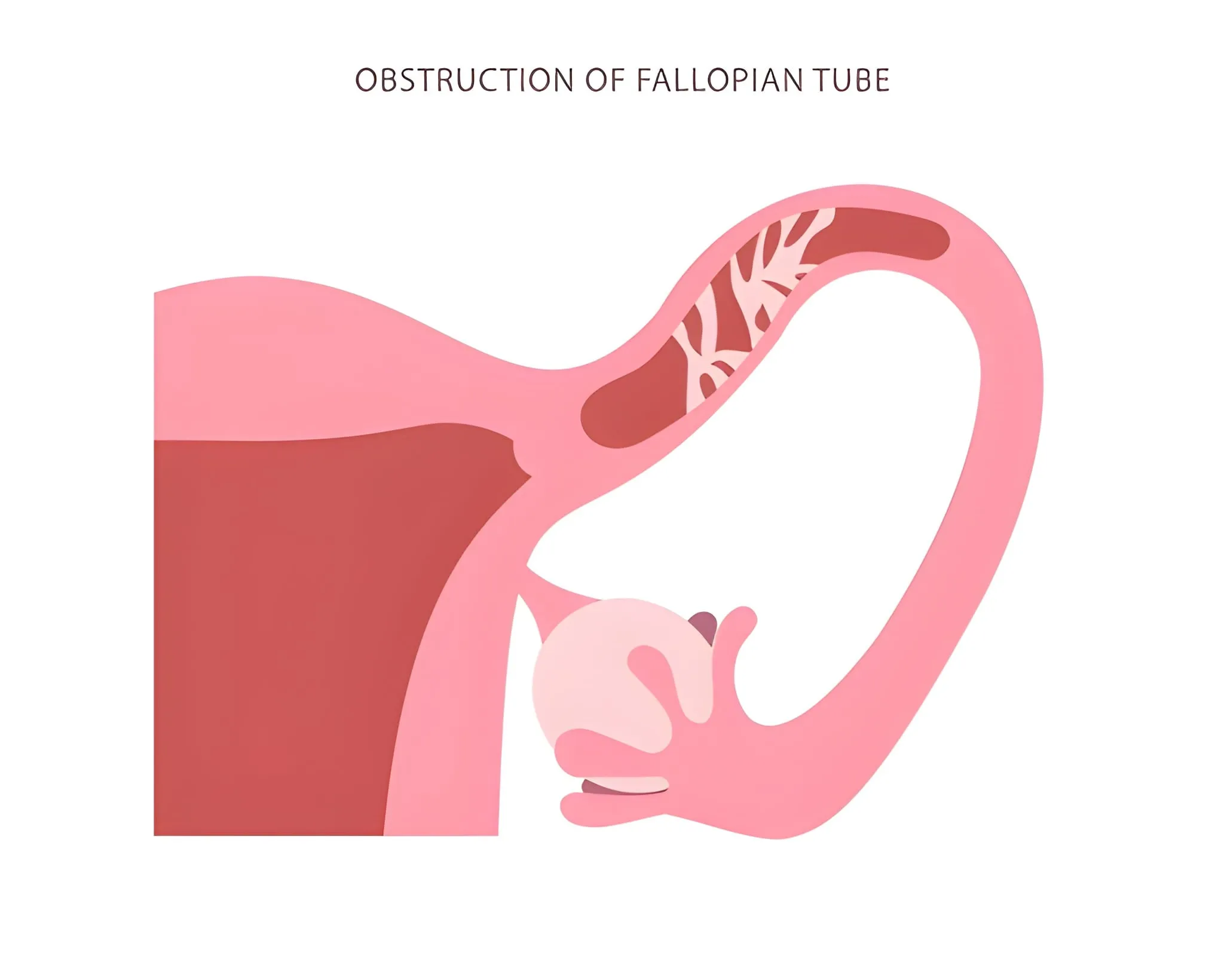 Fallopian Tube Recanalization