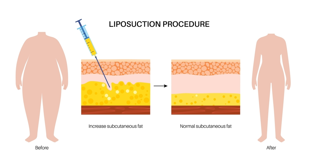 Liposuction
