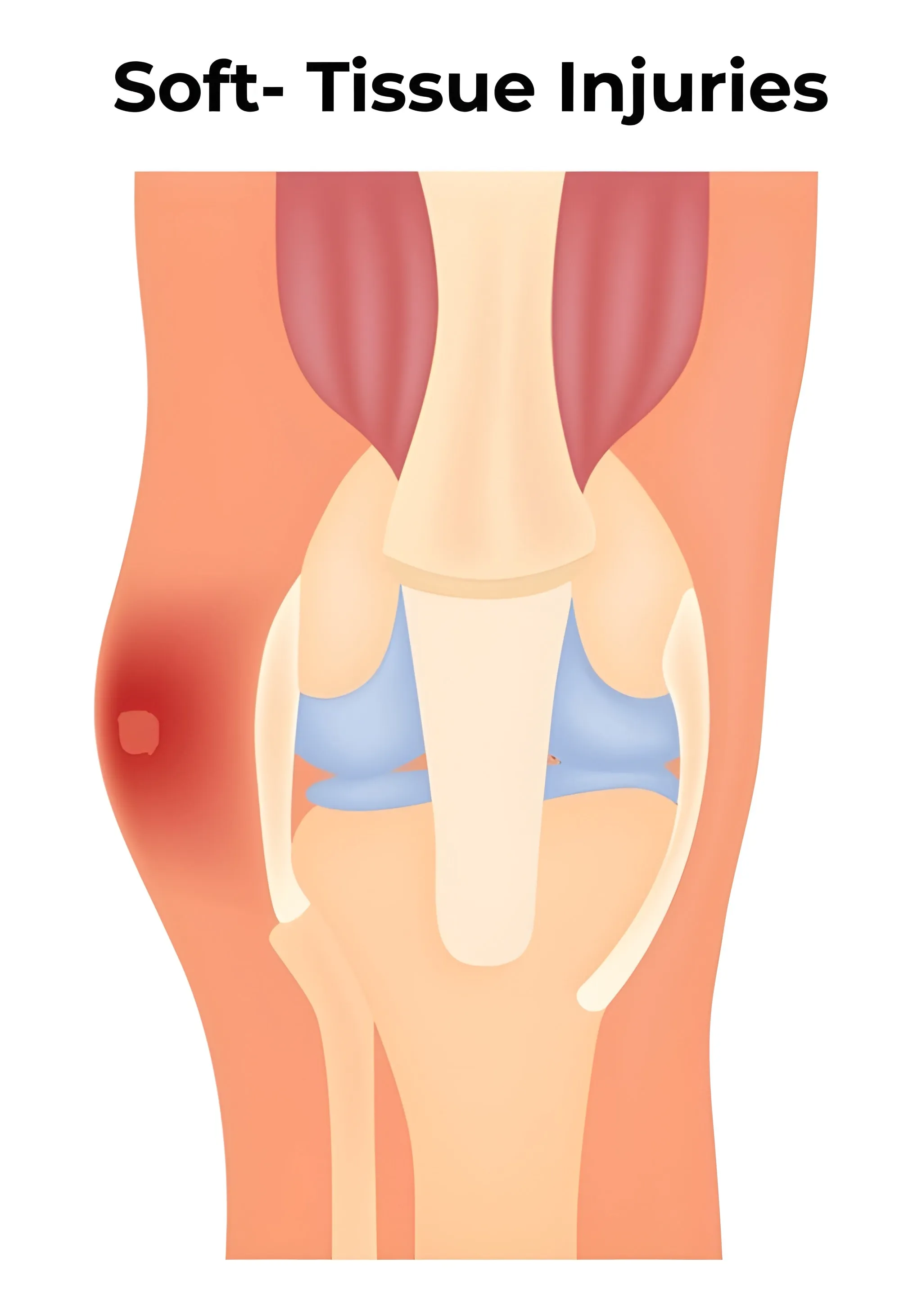 Soft Tissue Injury