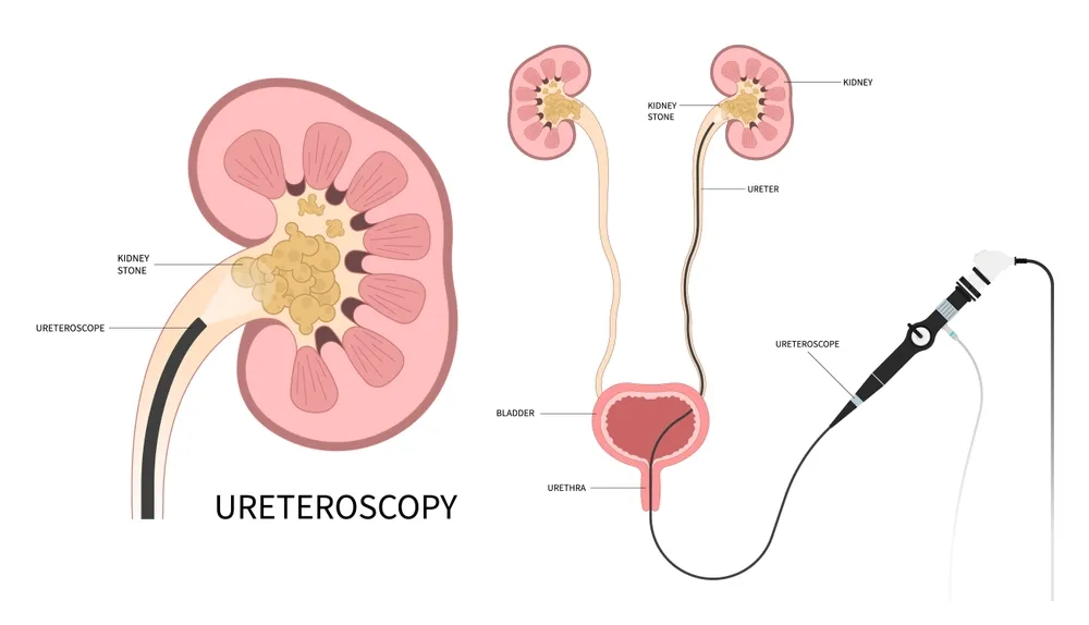 Ureteroscopic Procedures