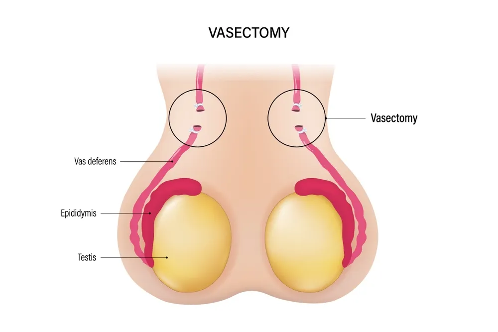 Vasectomy